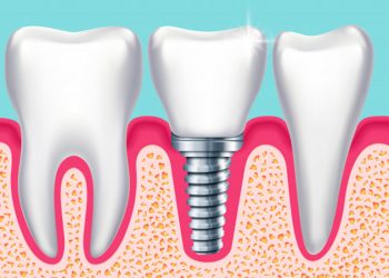implantes-dentales-en-murcia